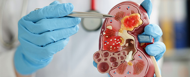 a hand in a blue latex glove uses tweezers to point to part of a plastic model of a kidney